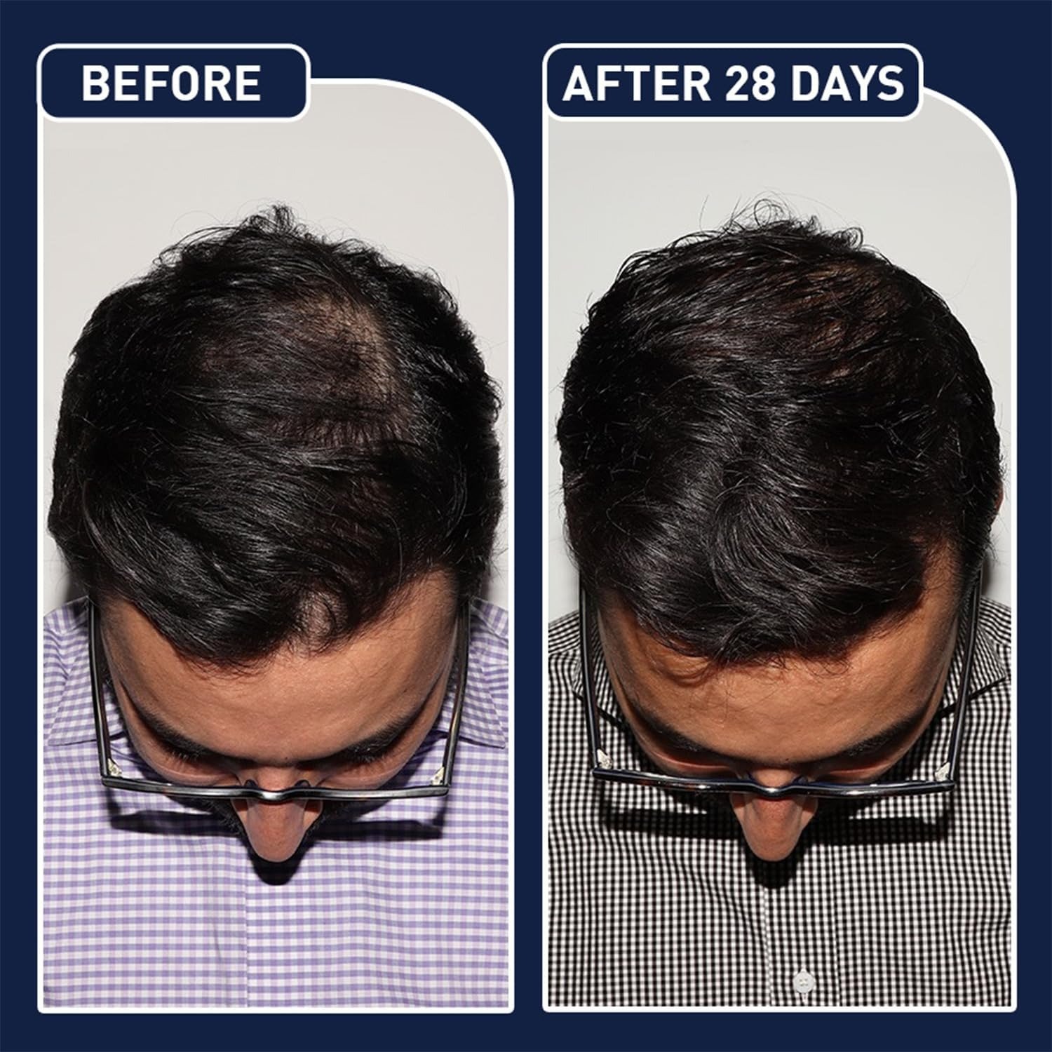 fegplus minoxidil beard & hair growth serum fegplus minoxidil beard & hair growth serum