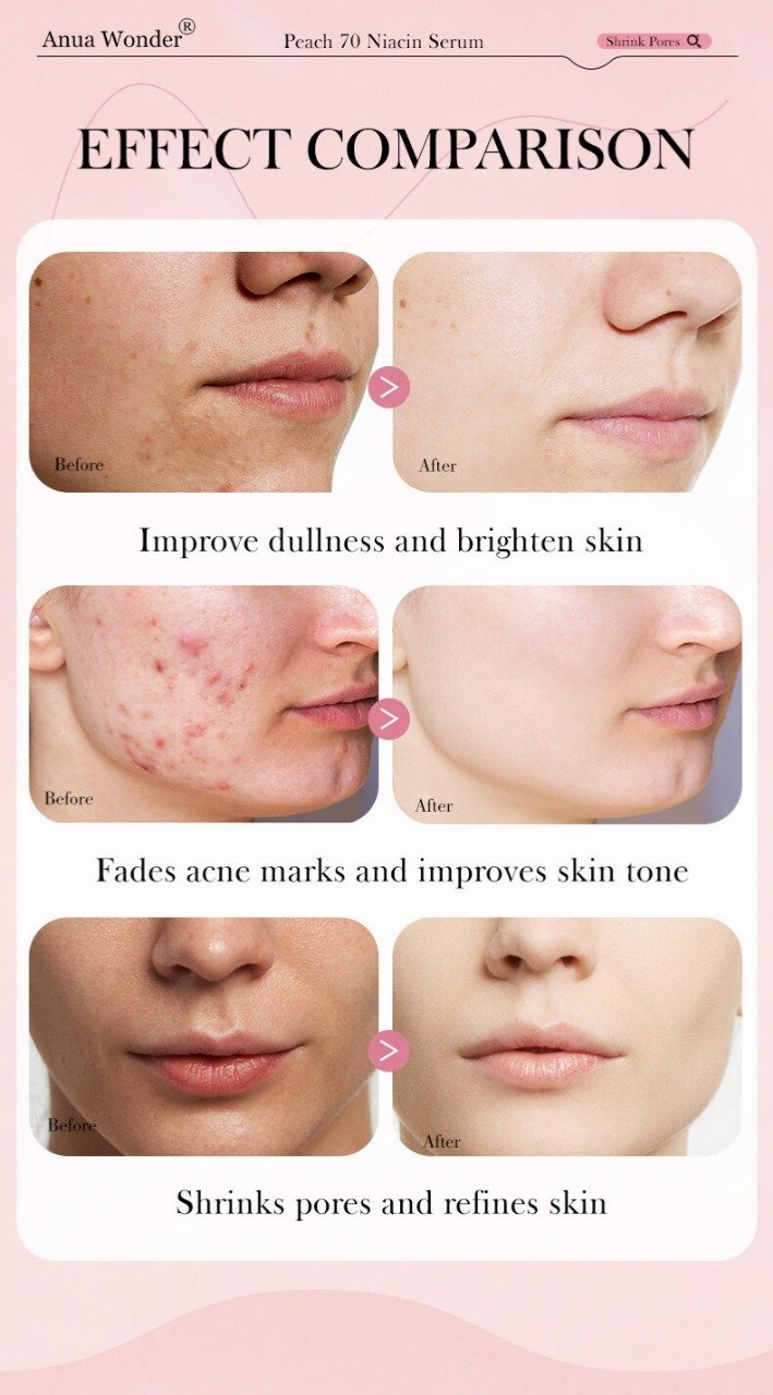anua wonder peach 70% niacinamide serum anua wonder peach 70% niacinamide serum